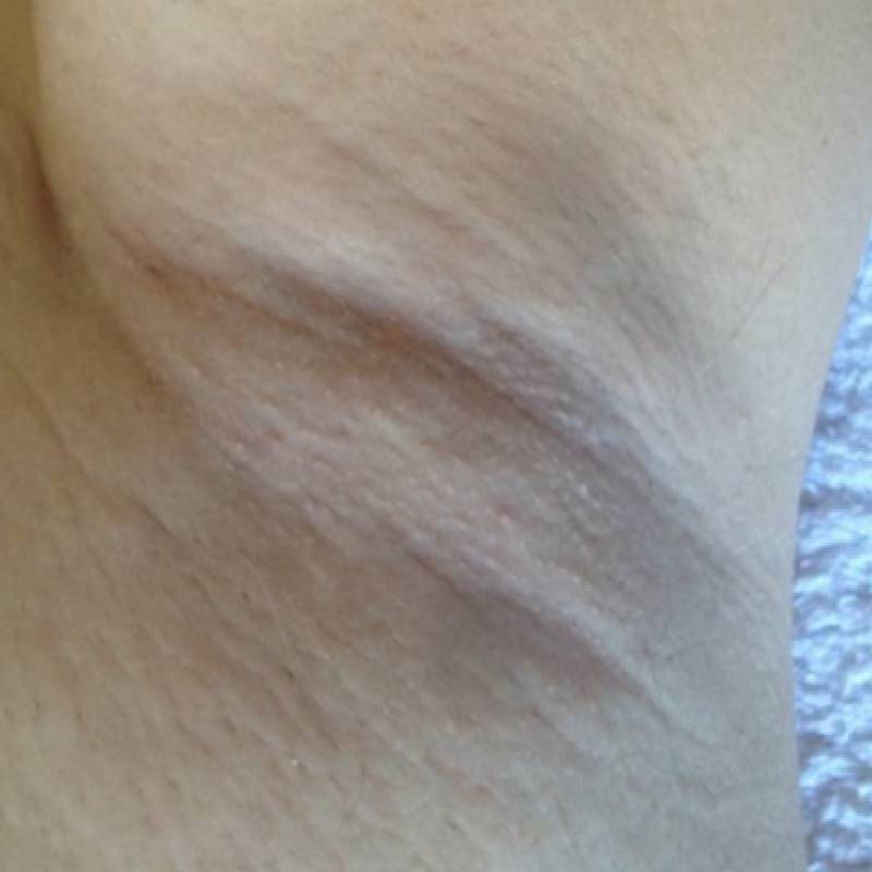 Laser Hair Removal after treatment