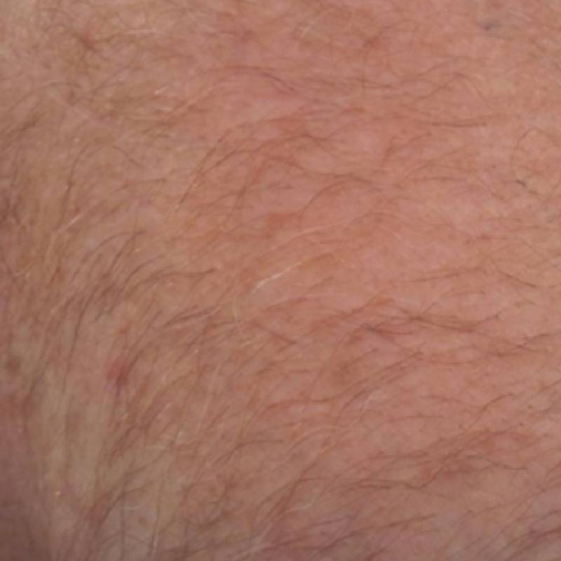 Laser Hair Removal Leicester before treatment