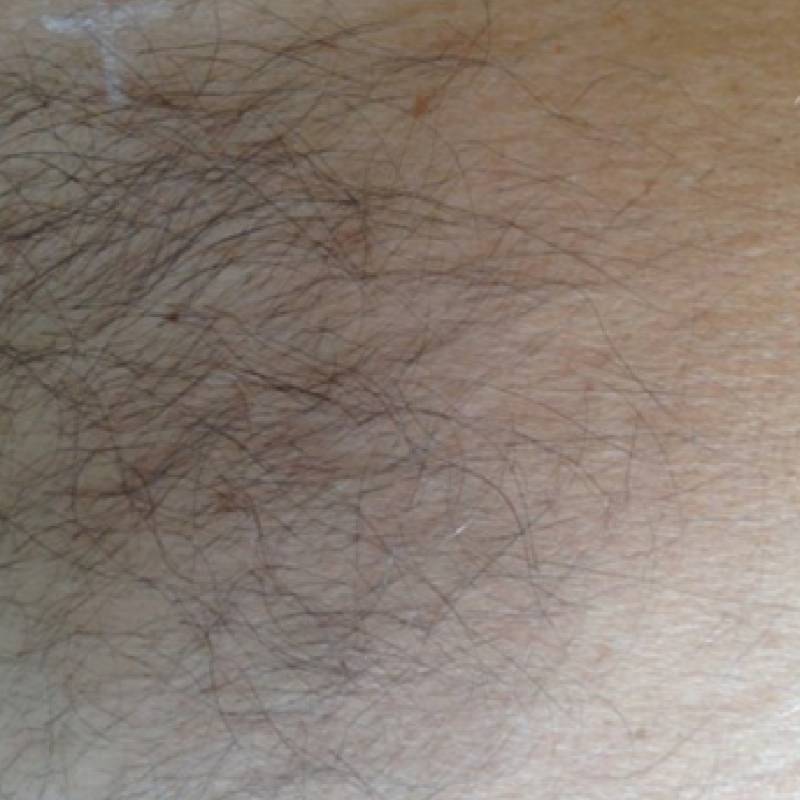 Body hair removal before