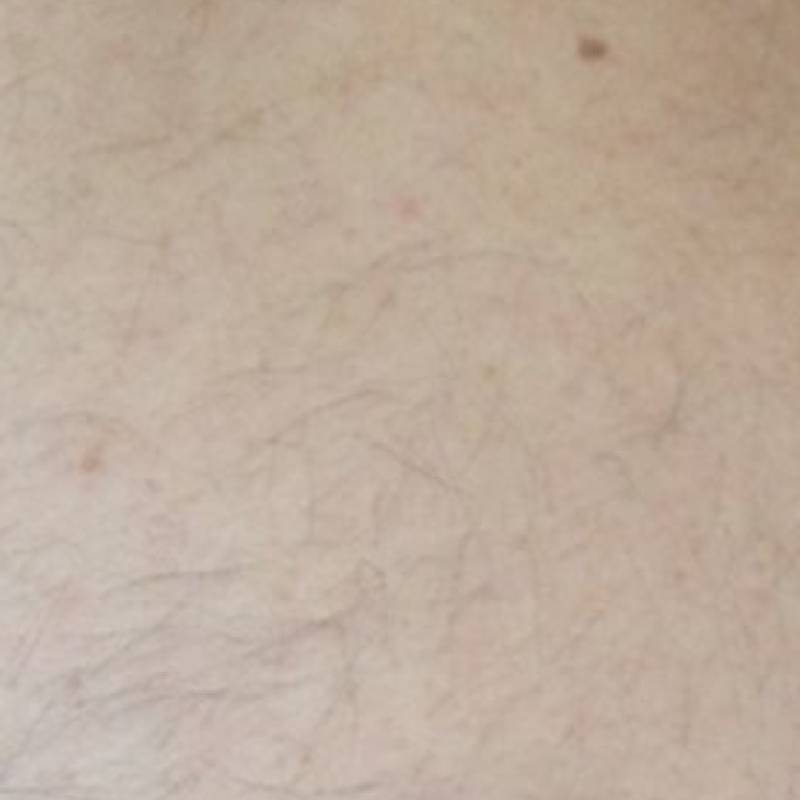 Body hair removal after