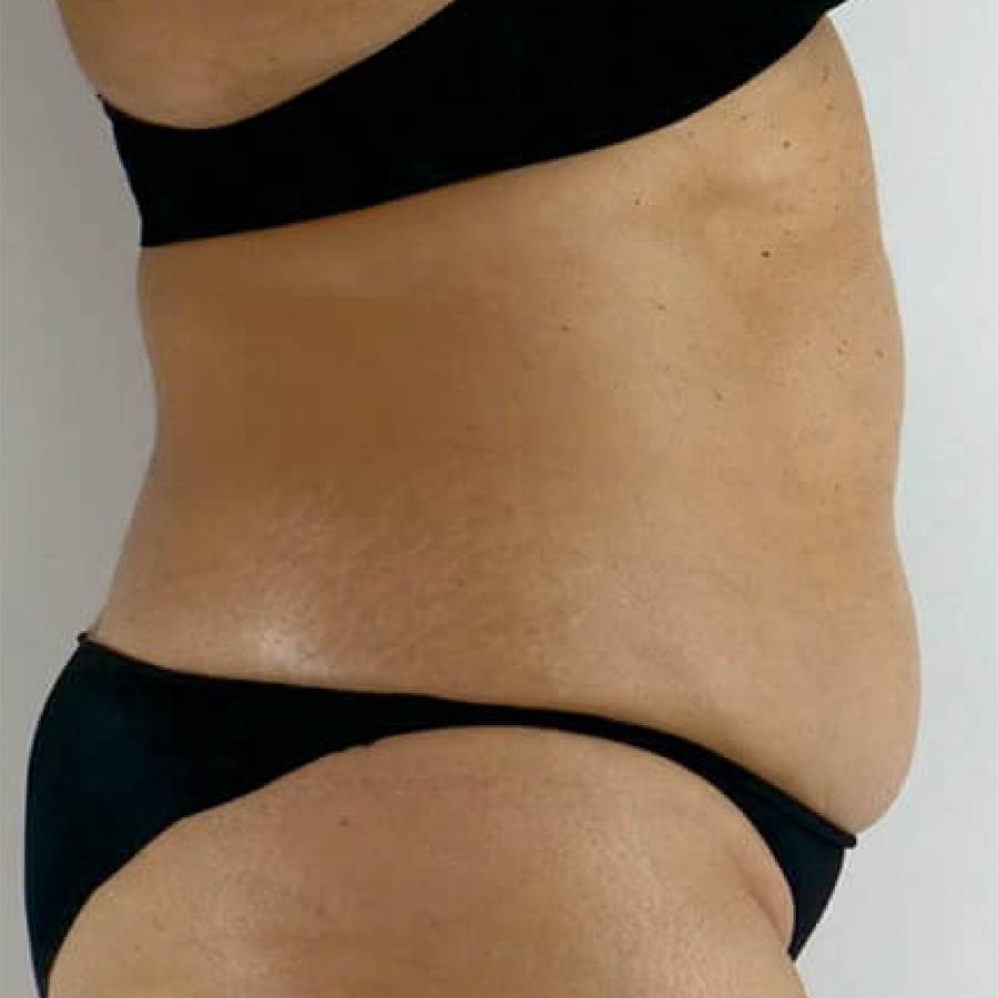 Body Sculpting - after treatment