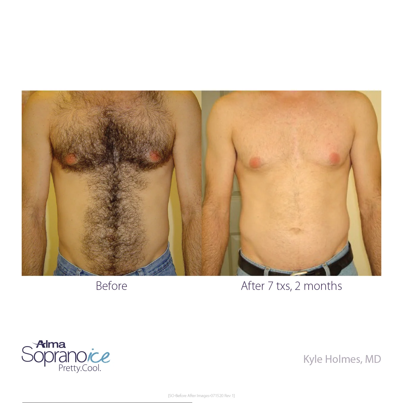 Soprano_ICE-Before_and_After-B2C-1-Hair_Removal_1648570120