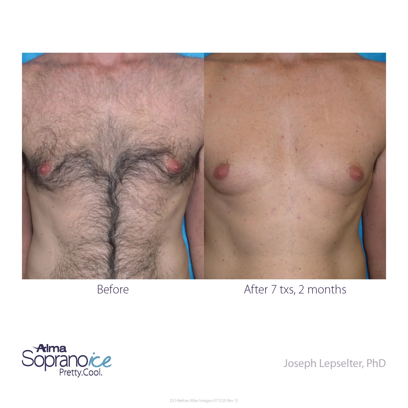 Soprano_ICE-Before_and_After-B2C-2-Hair_Removal_1648570119