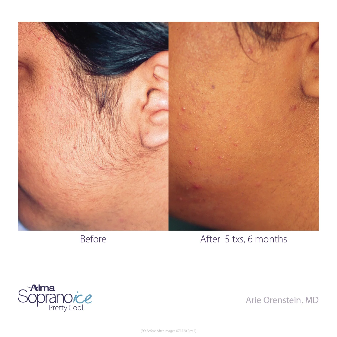Soprano_ICE-Before_and_After-B2C-3-Hair_Removal_1648570120