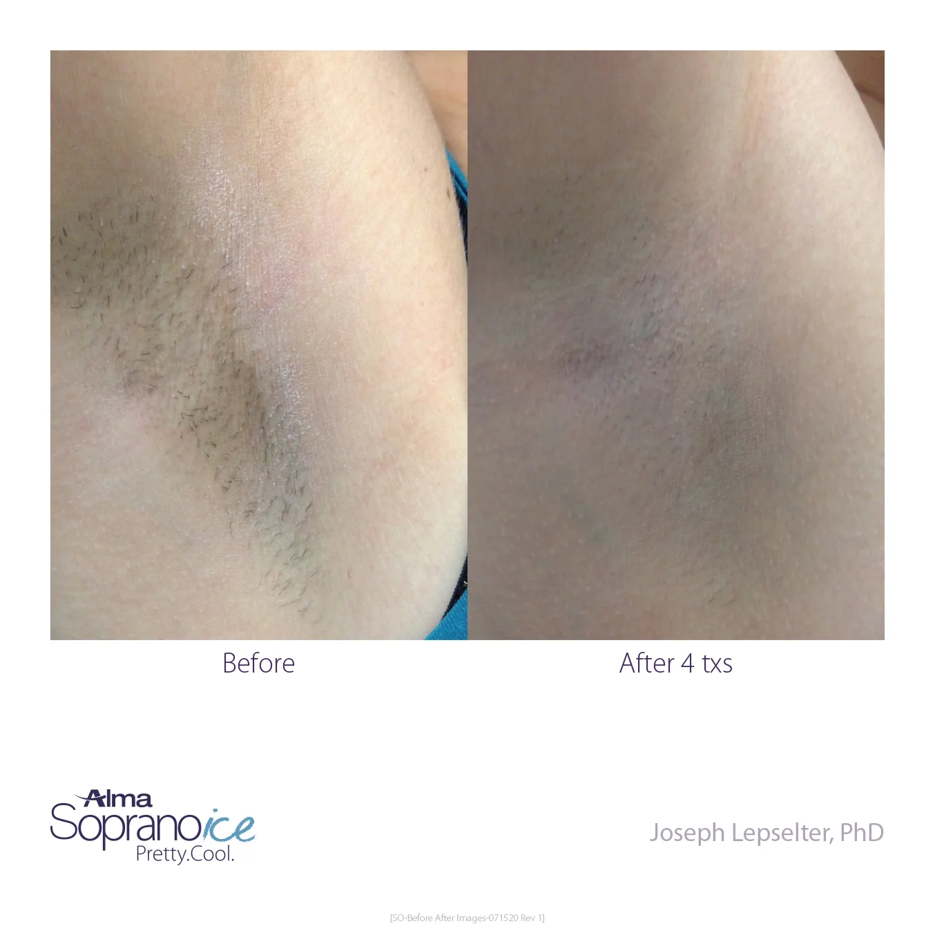 Soprano_ICE-Before_and_After-B2C-4-Hair_Removal_1648570120