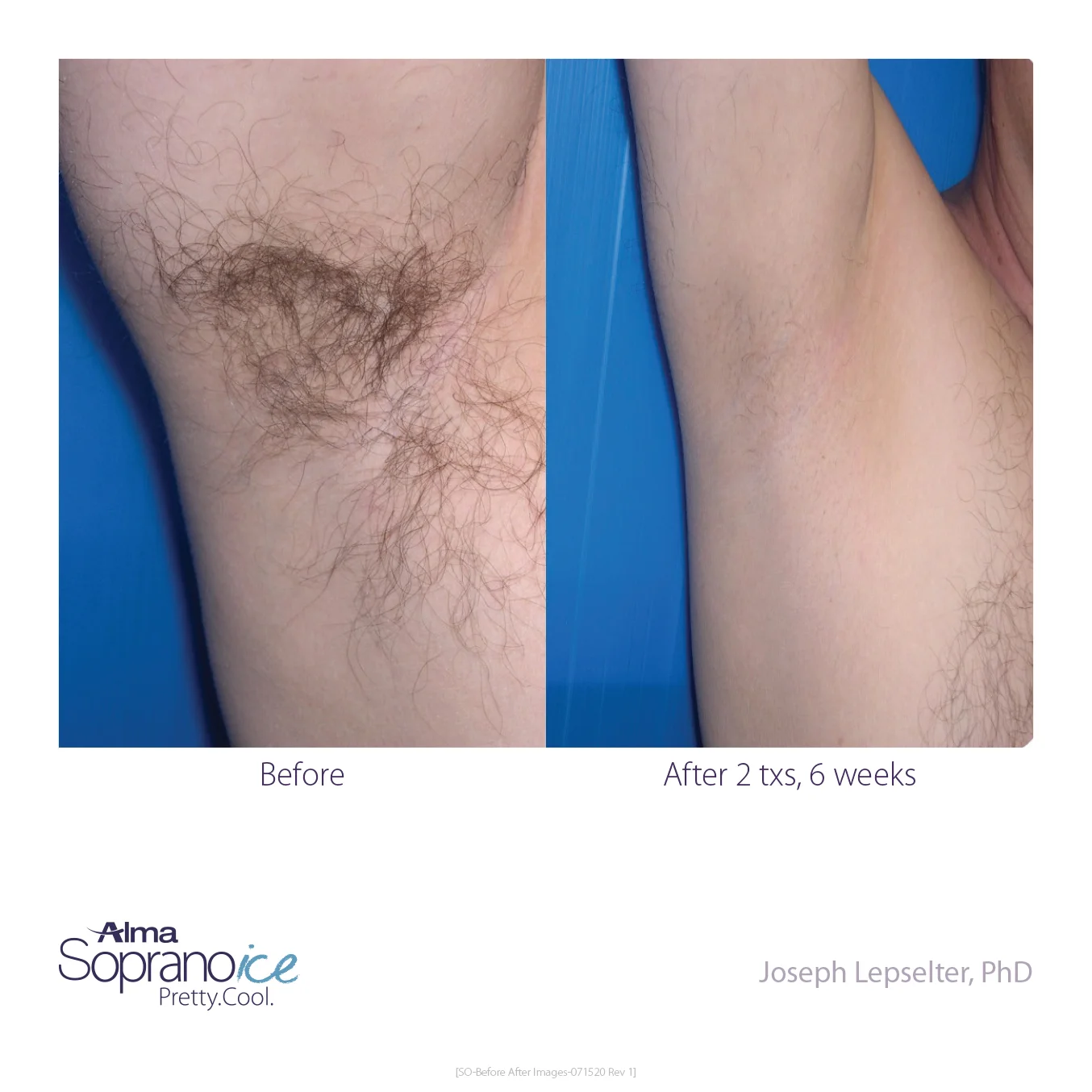 Soprano_ICE-Before_and_After-B2C-5-Hair_Removal_1648570120