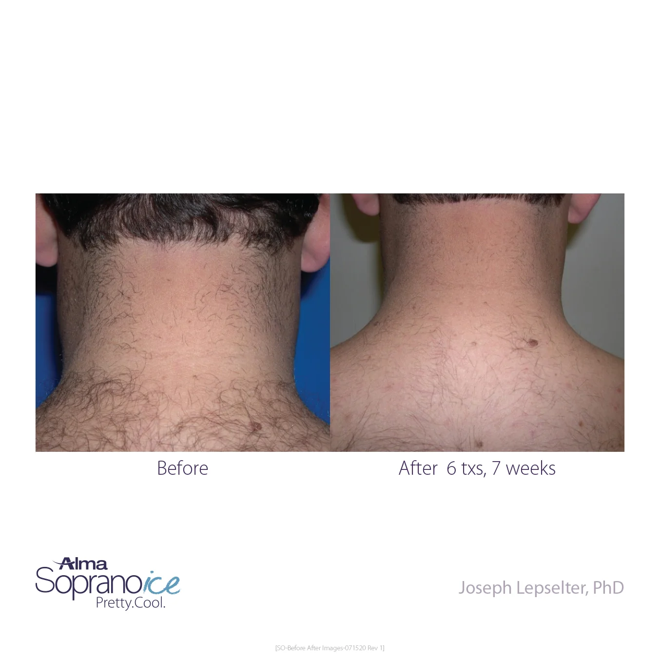 Soprano_ICE-Before_and_After-B2C-8-Hair_Removal_1648570120